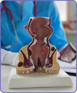 Hemorrhoid Artery Embolization (HAE) Near Me in Houston, TX 
