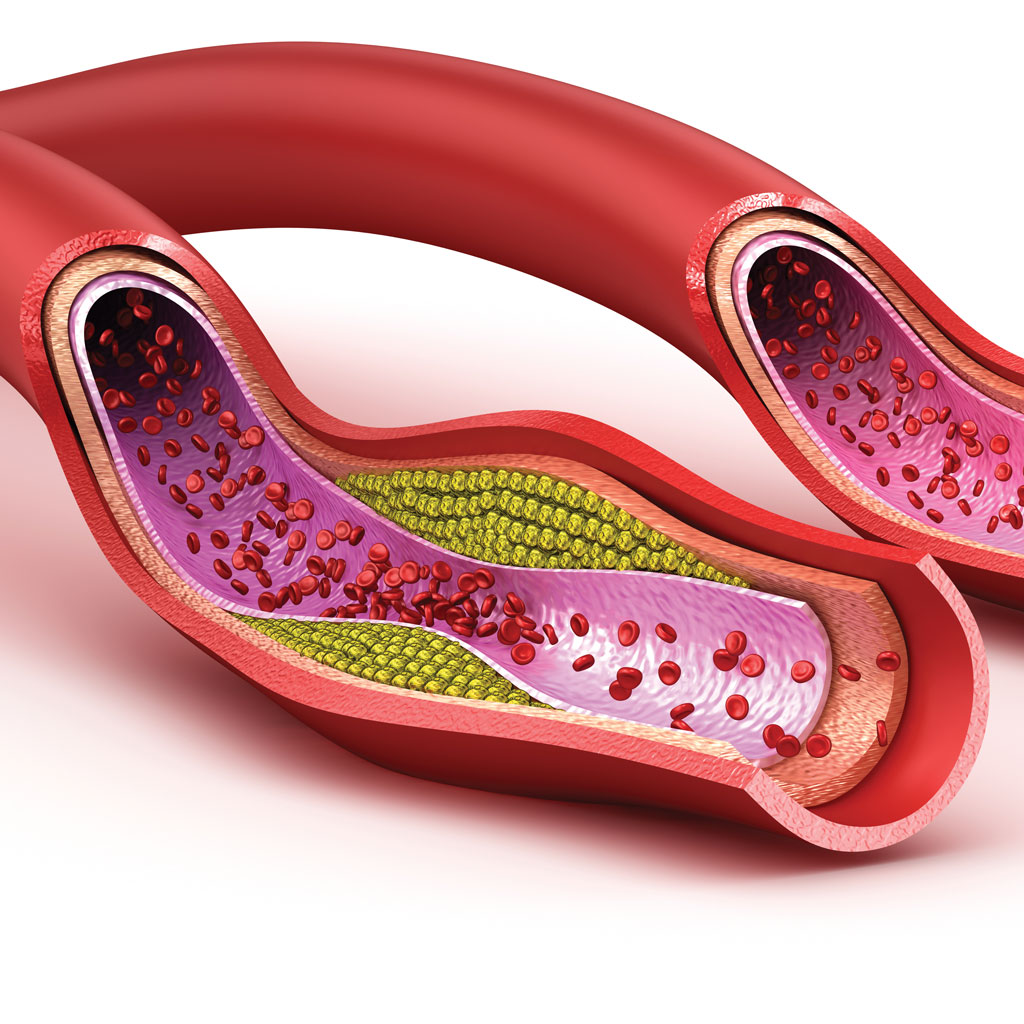 Signs and Symptoms of PAD Illustration