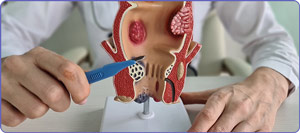 Hemorrhoid Artery Embolization vs Banding: What Is the Difference? | Alate Health in Houston TX