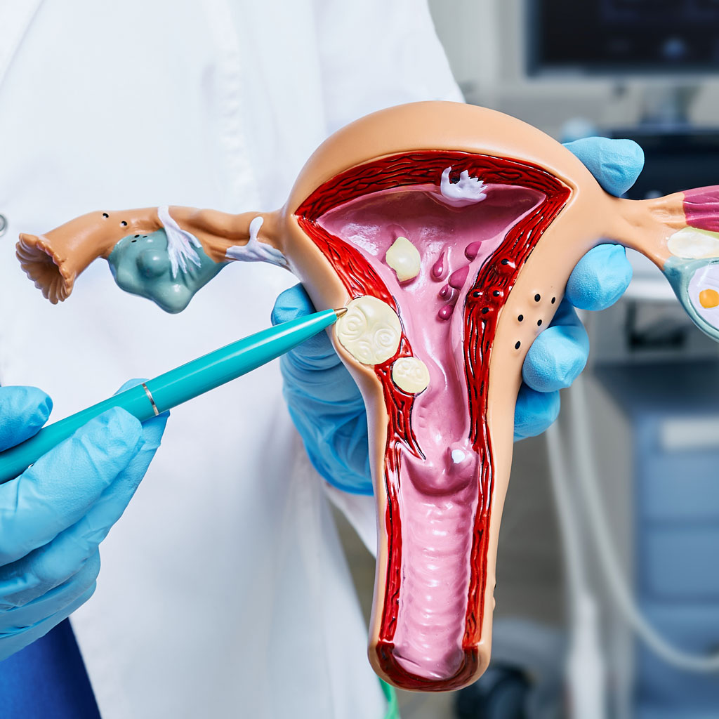 Doctor Showing Uterus Model Benefits of UFE Over Hysterectomy