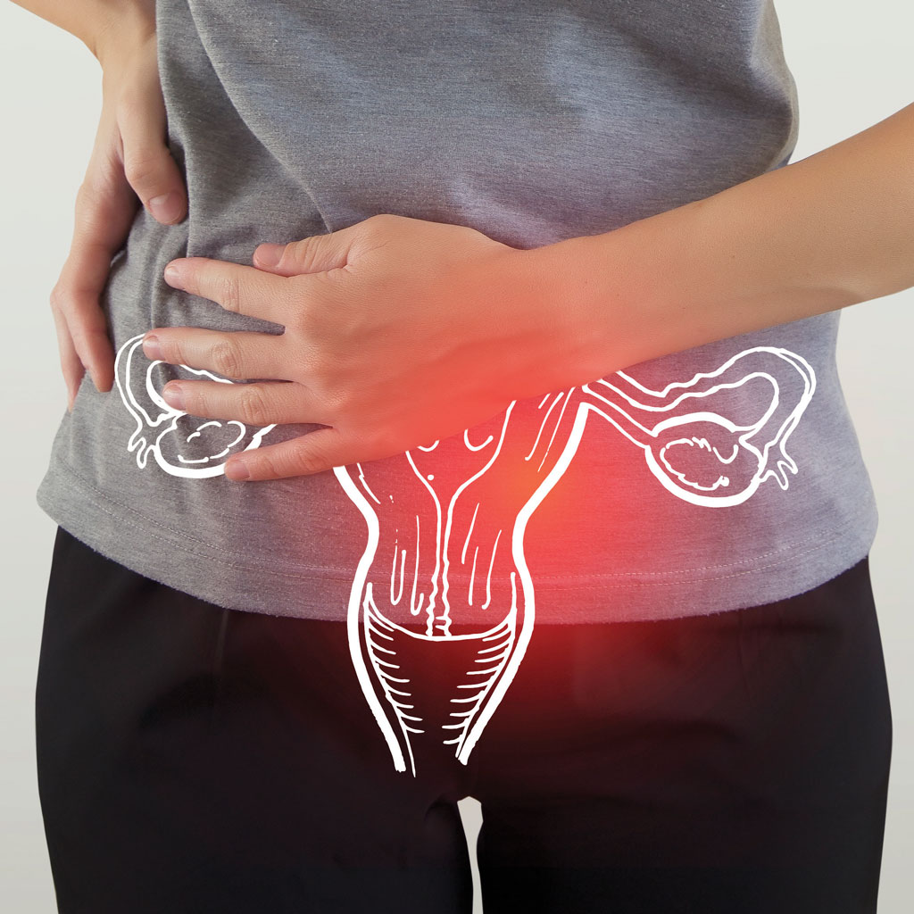 Woman Experiencing Pelvic Congestion Syndrome